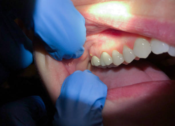 Best Emergency Wisdom Tooth Extraction in Warner Robins, GA
